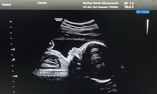 2D Heartbeat Ultrasound